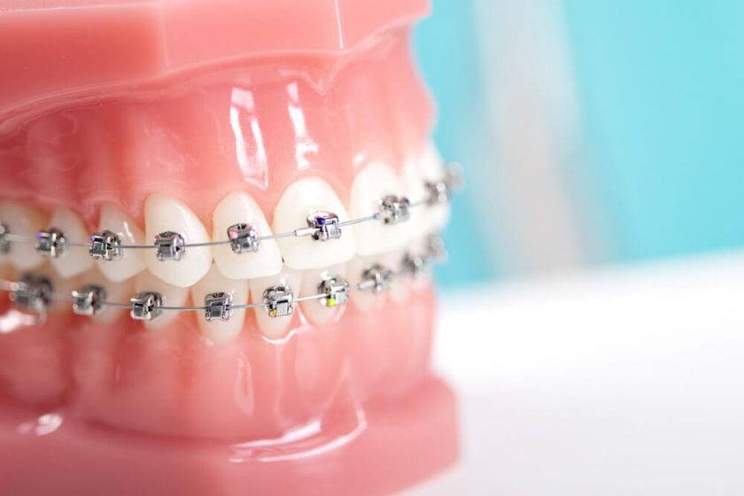 จัดฟันแบบไม่ใส่ยางจัดฟัน – Bkk-Dental.Com